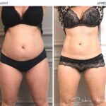 avant-apres-amincissement-ventre-coolsculpting-1.jpg
